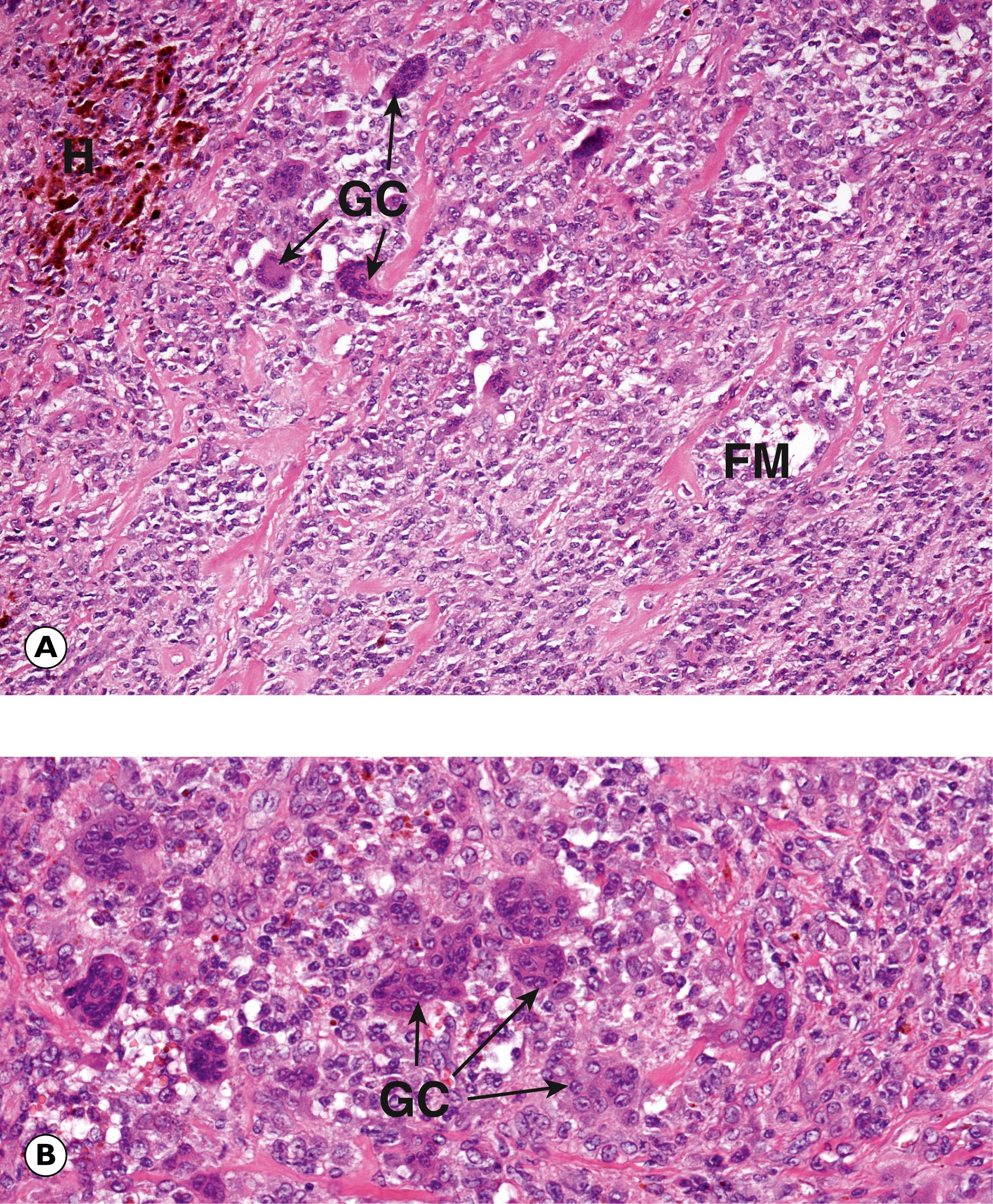 Fig. 22.14, Giant cell tumour of tendon sheath (nodular tenosynovitis). (A) LP; (C) HP.