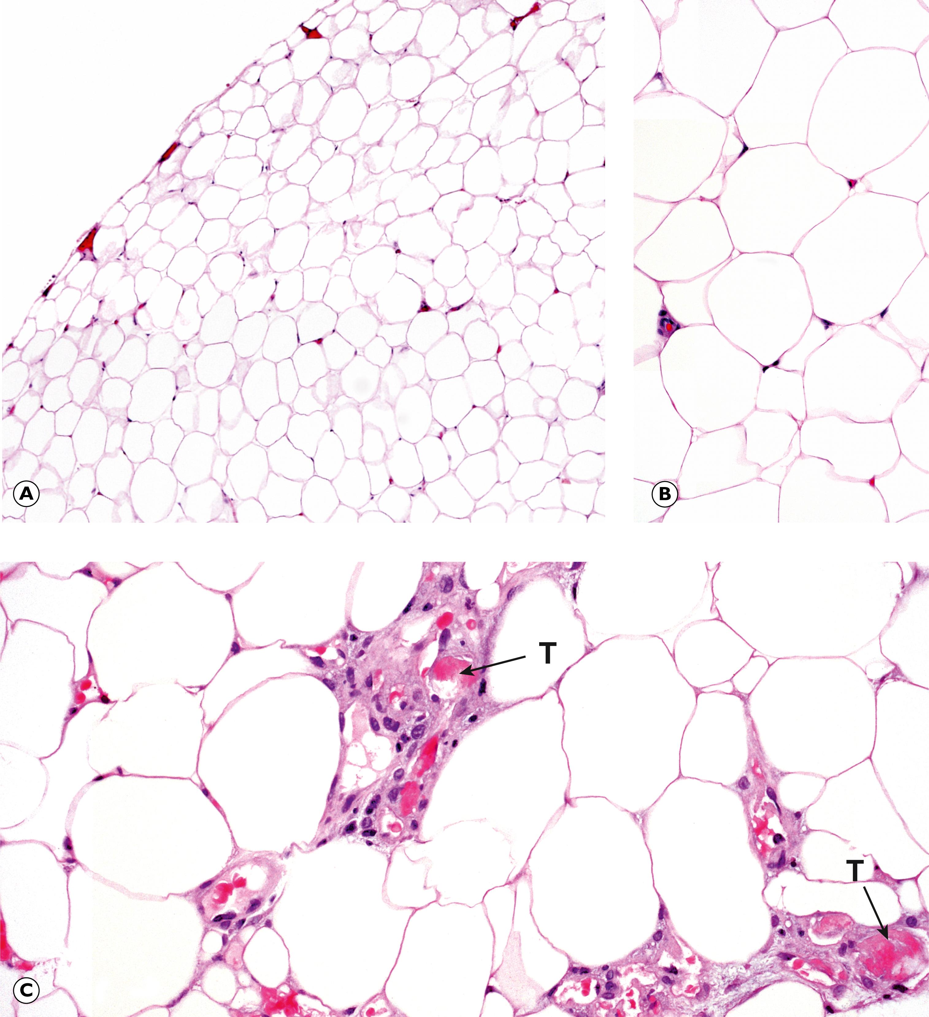 Fig. 22.15, Lipoma. (A) Lipoma (LP); (B) lipoma (HP); (C) angiolipoma (HP).