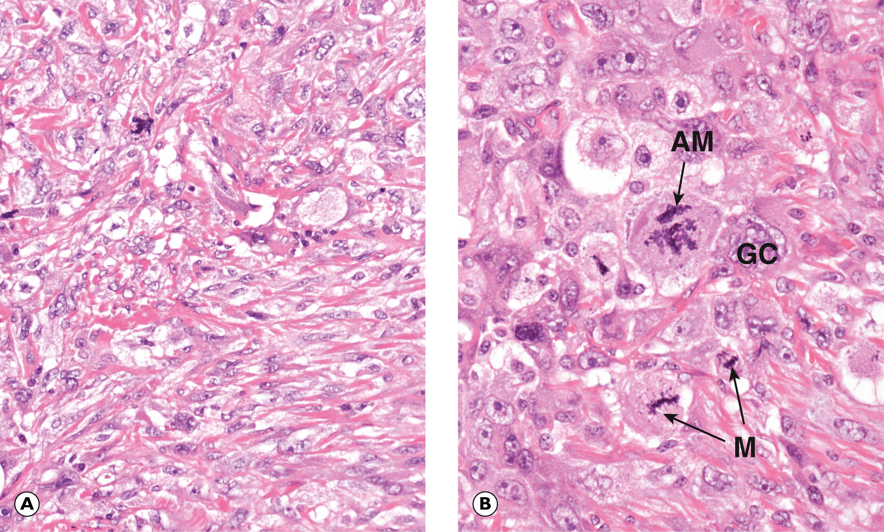 Fig. 22.17, Undifferentiated pleomorphic sarcoma. (A) MP; (B) HP.