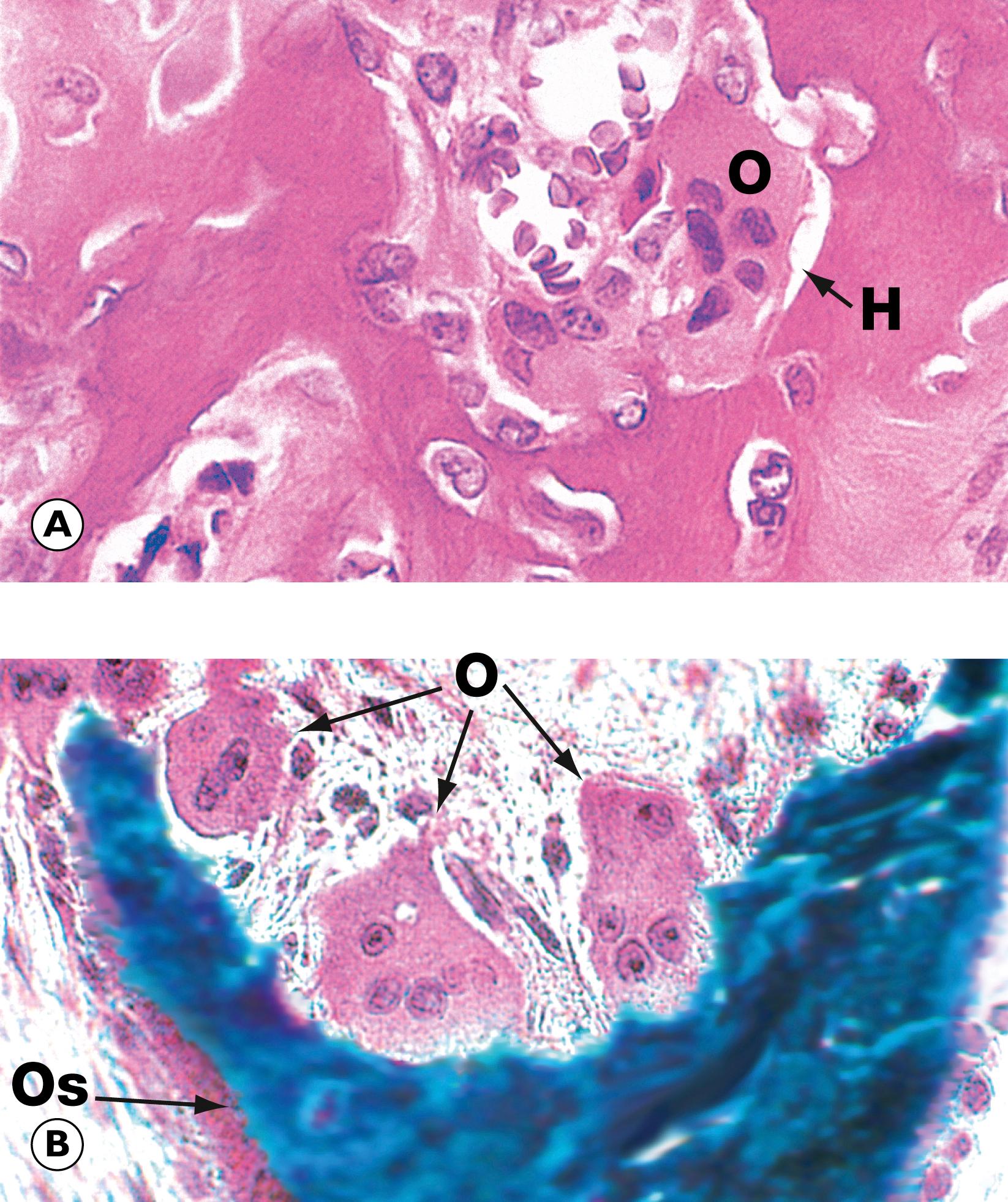 E-Fig. 22.3 H, Osteoclasts. (A) H&E (HP); (B) undecalcified resin section, Goldner’s trichrome (HP).