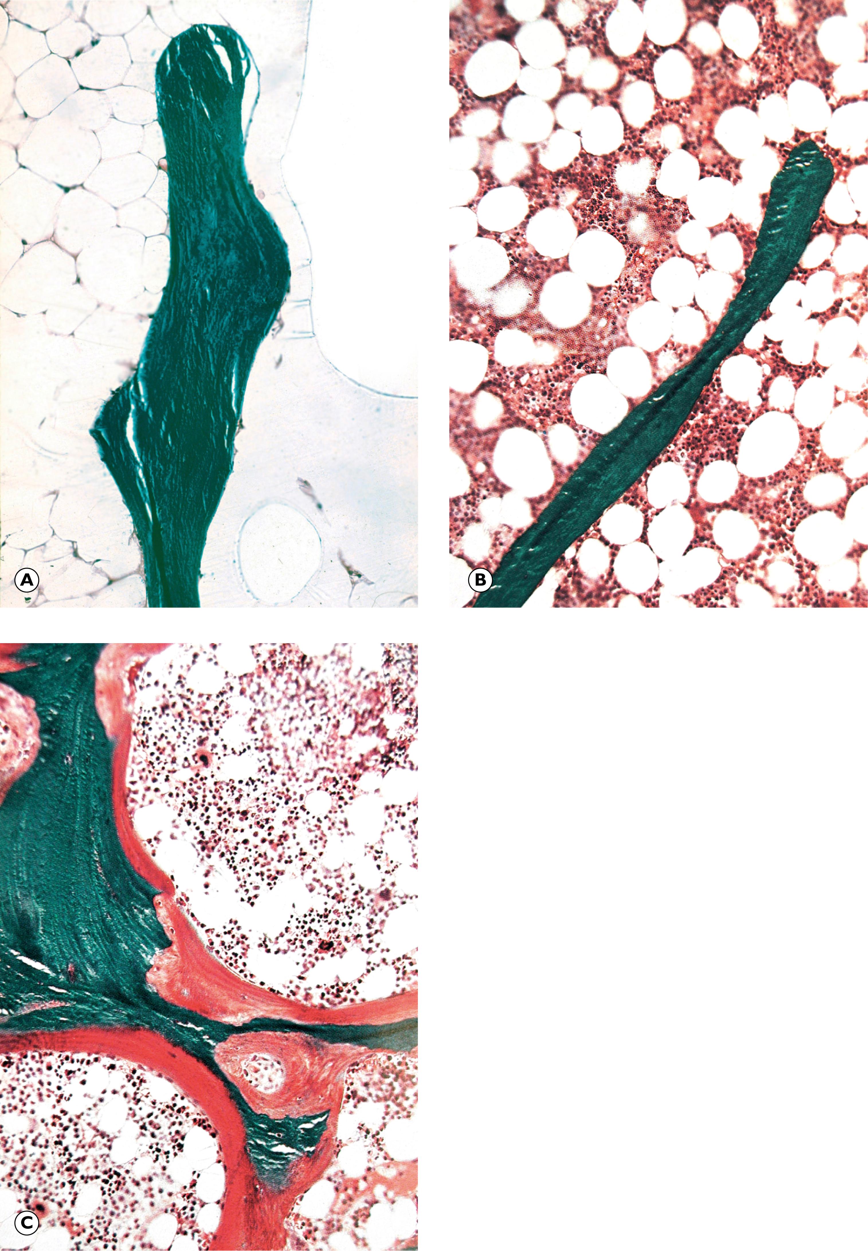 Fig. 22.2, Osteoporosis and osteomalacia (undecalcified resin sections, Goldner’s trichrome) (MP). (A) Normal bone; (B) osteoporosis; (C) osteomalacia.