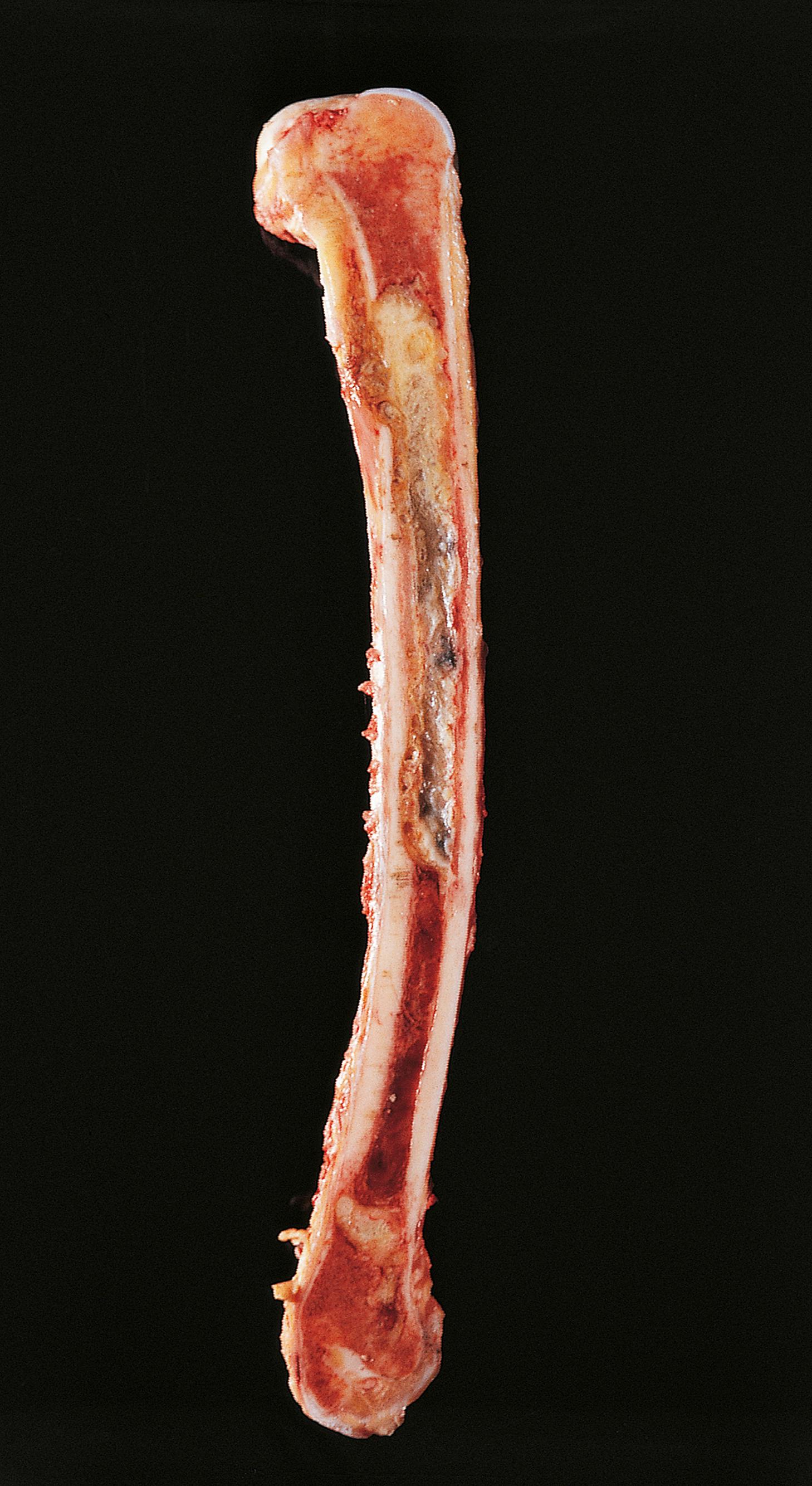 E-Fig. 22.4 G, Acute osteomyelitis.