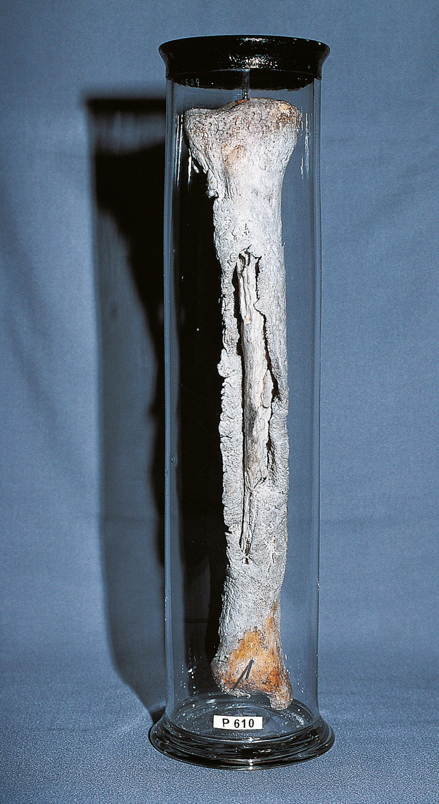 E-Fig. 22.5 G, Chronic osteomyelitis.