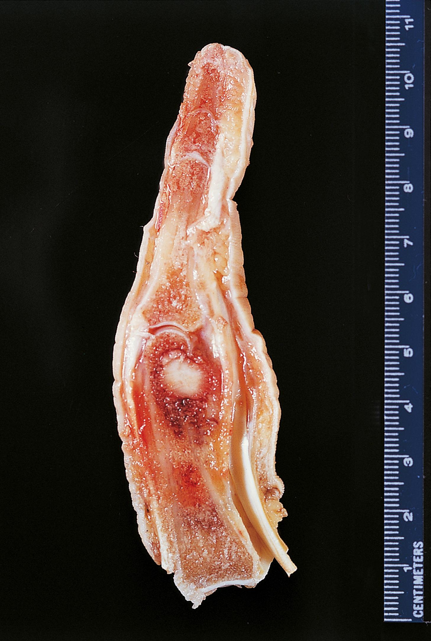 E-Fig. 22.8 G, Osteoid osteoma in the proximal phalanx of a finger.