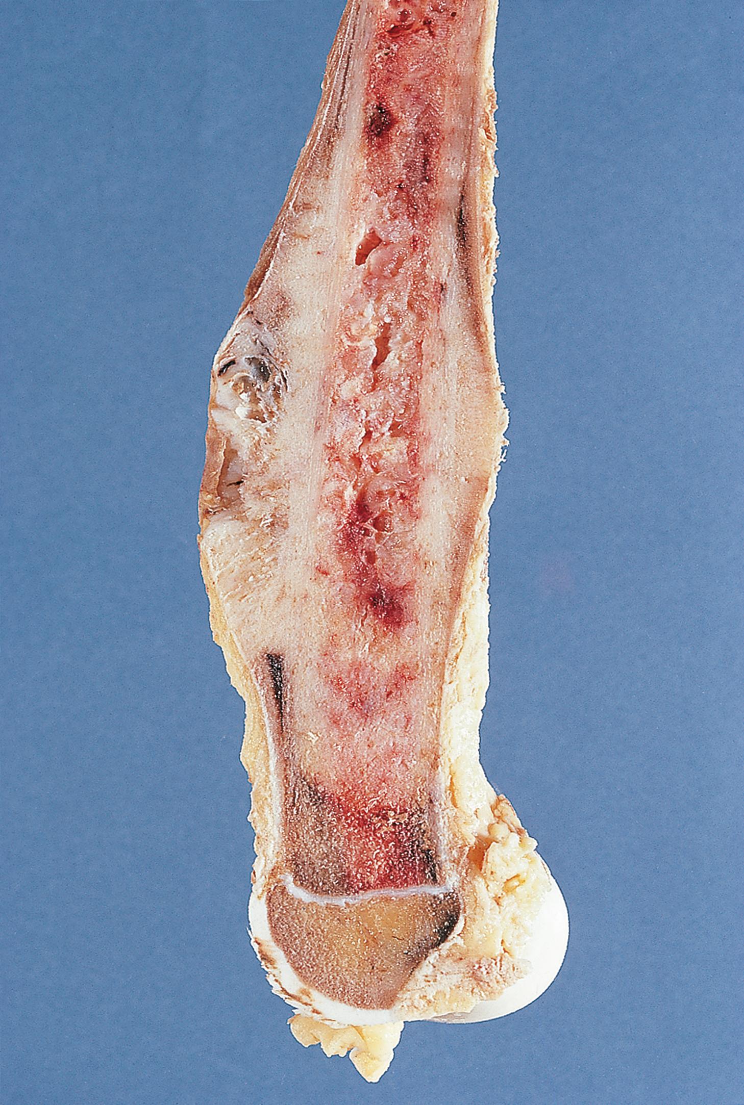 E-Fig. 22.9 G, Osteogenic sarcoma.