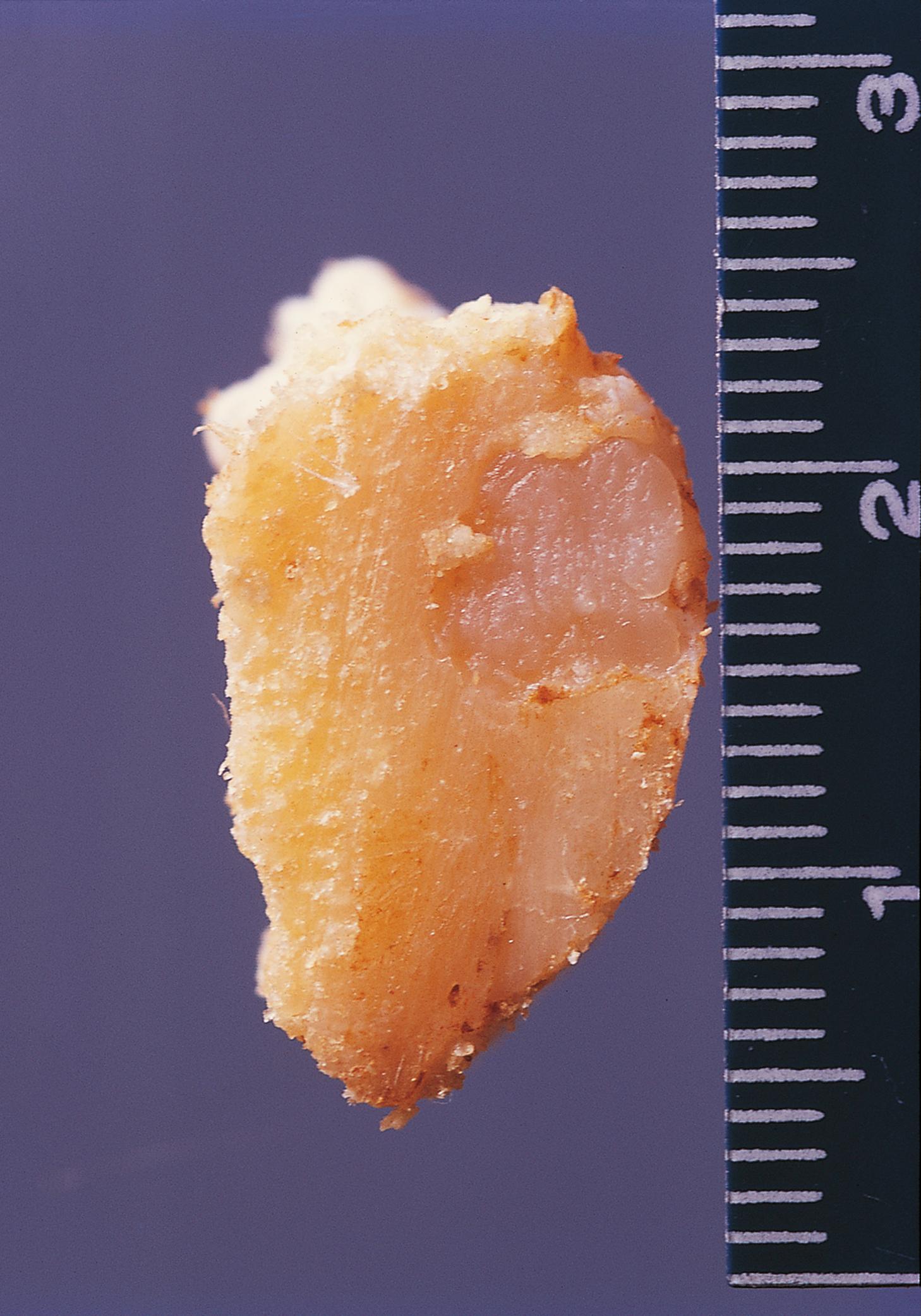 E-Fig. 22.11 G, Benign chondroma.