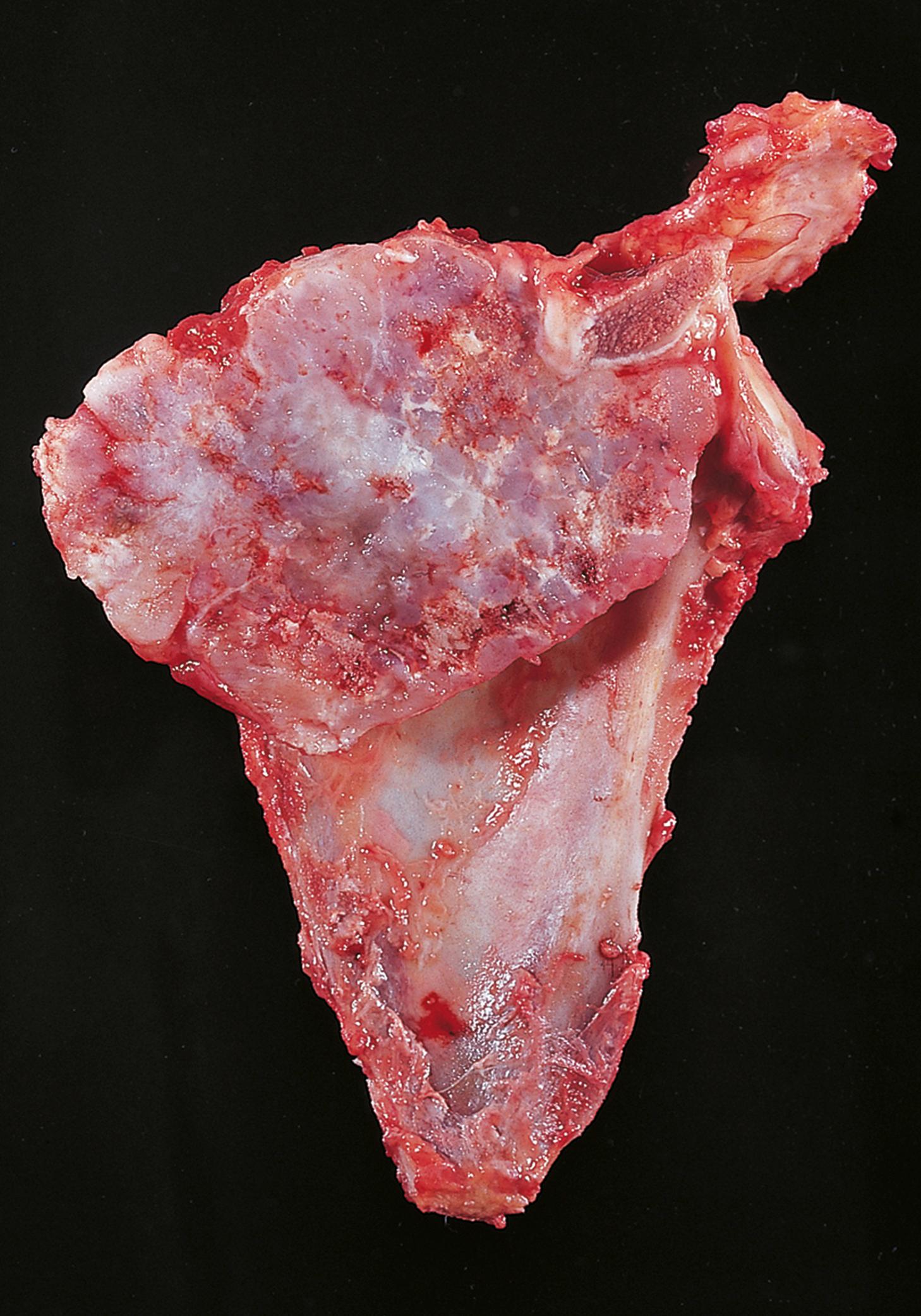 E-Fig. 22.12 G, Chondrosarcoma arising in the scapula.