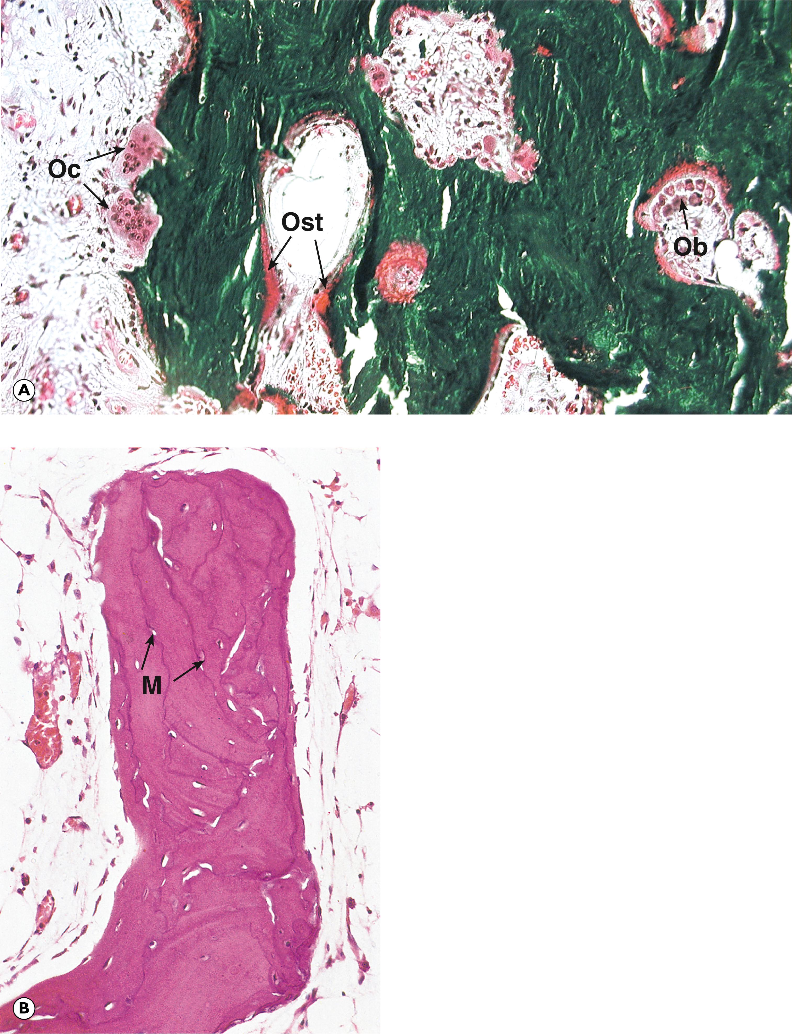 Fig. 22.3, Paget’s disease of bone (MP). (A) Active osteolytic lesion (undecalcified resin section, Goldner’s trichrome); (B) inactive sclerotic lesion (decalcified paraffin section, H&E).