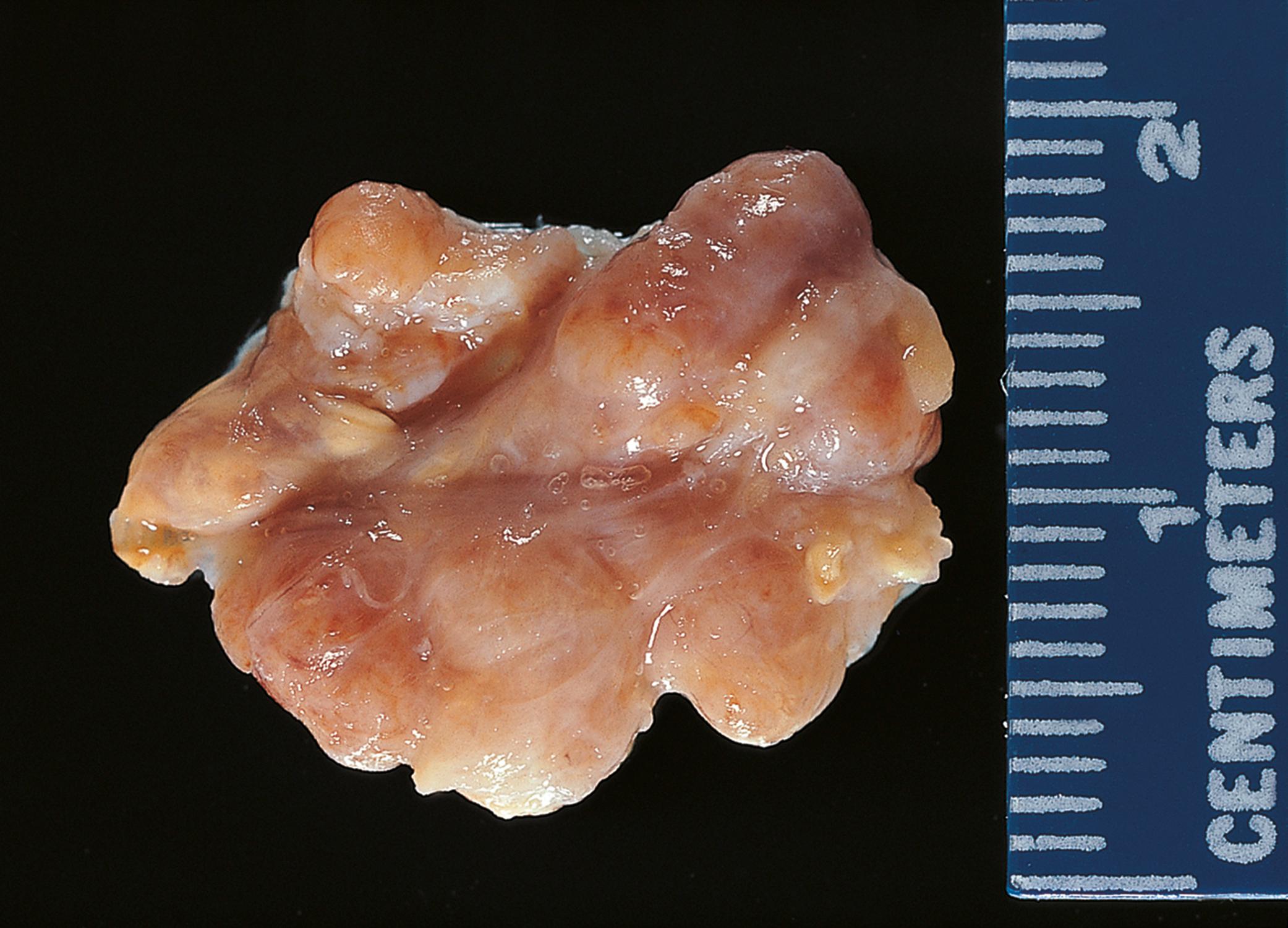 E-Fig. 22.15 G, Giant cell tumour of tendon sheath (nodular tenosynovitis).