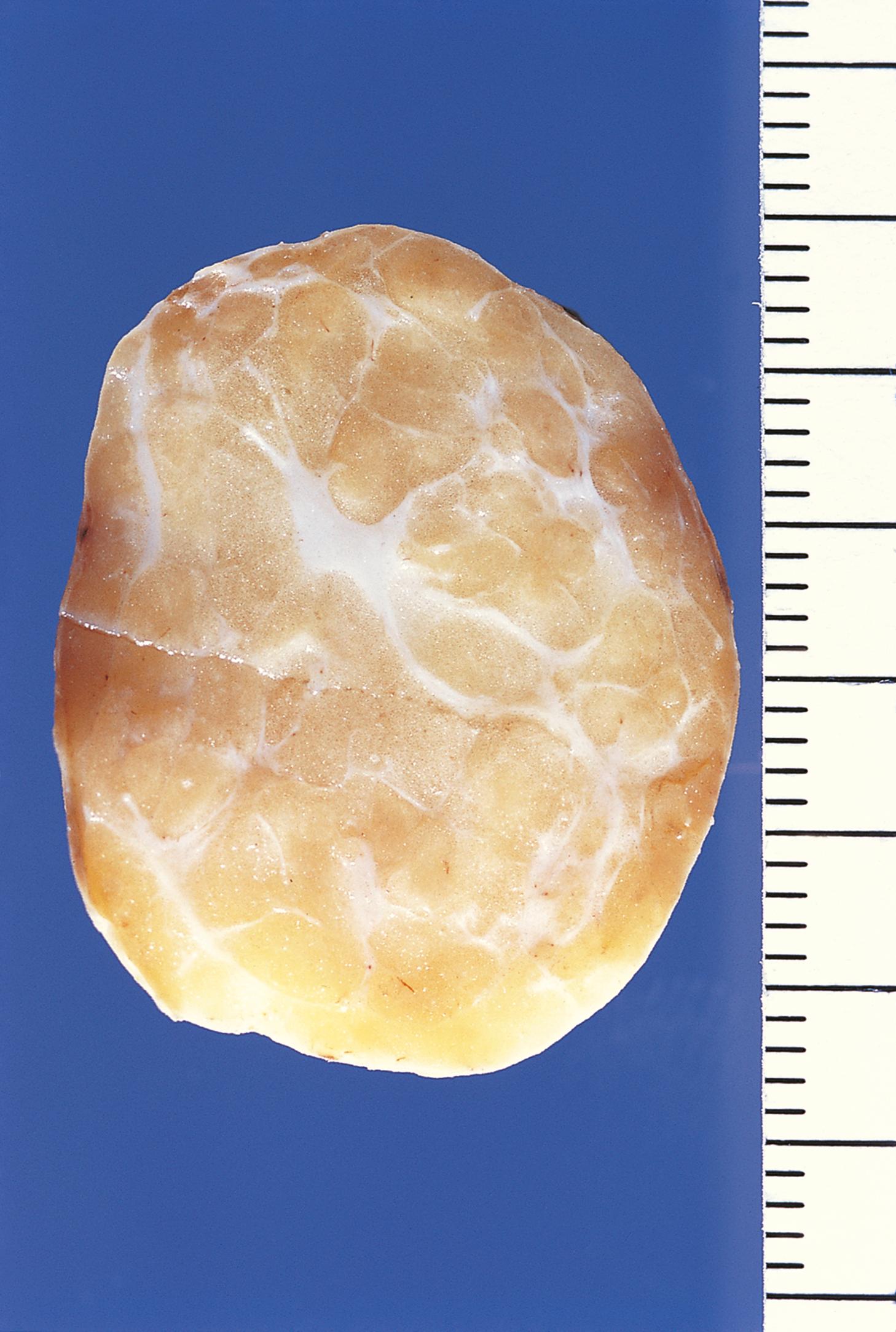 E-Fig. 22.17 G, Benign subcutaneous lipoma.