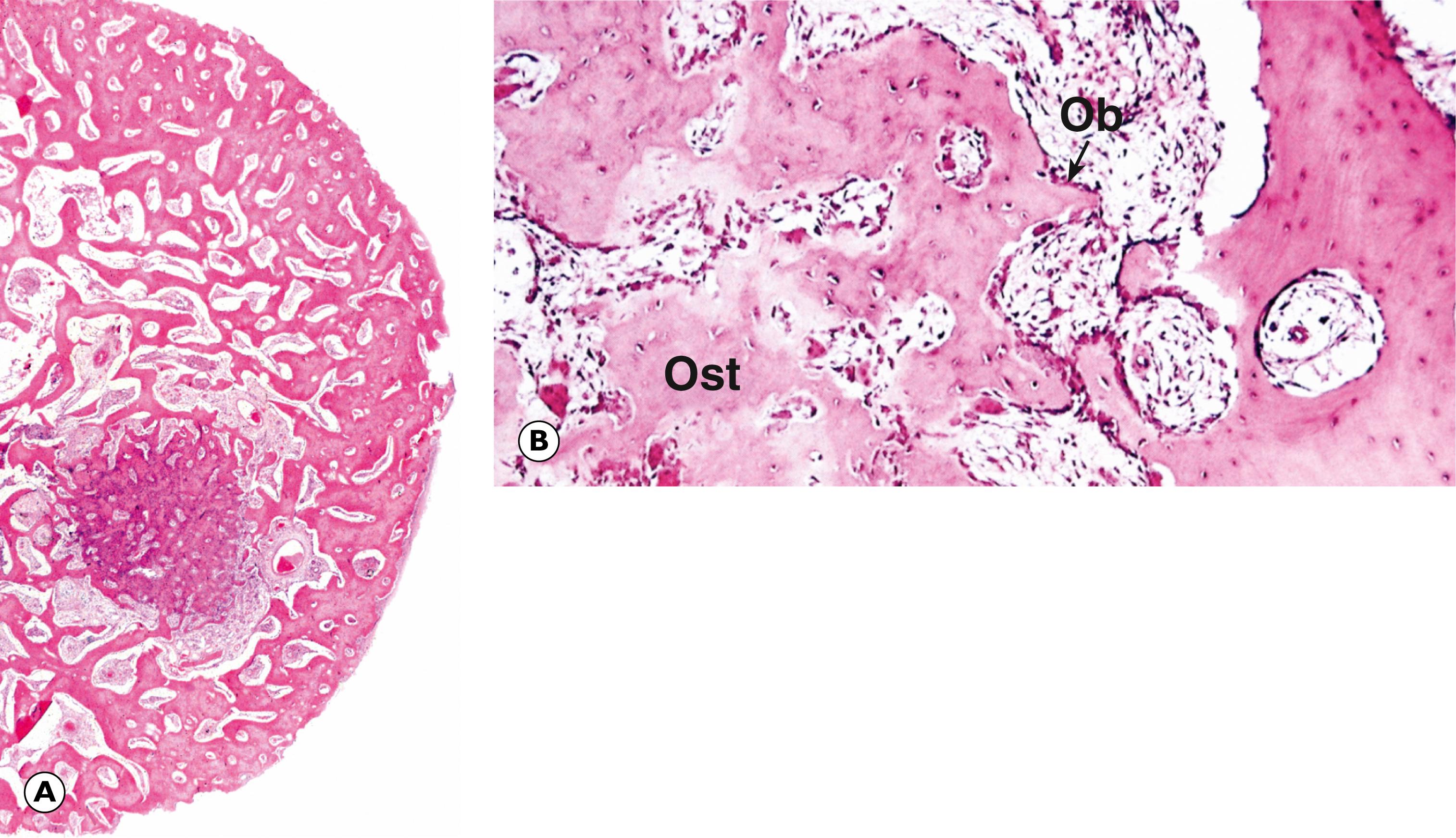 Fig. 22.4, Osteoid osteoma. (B) Osteoid osteoma in medullary cavity (LP); (B) histology of edge of lesion (MP).