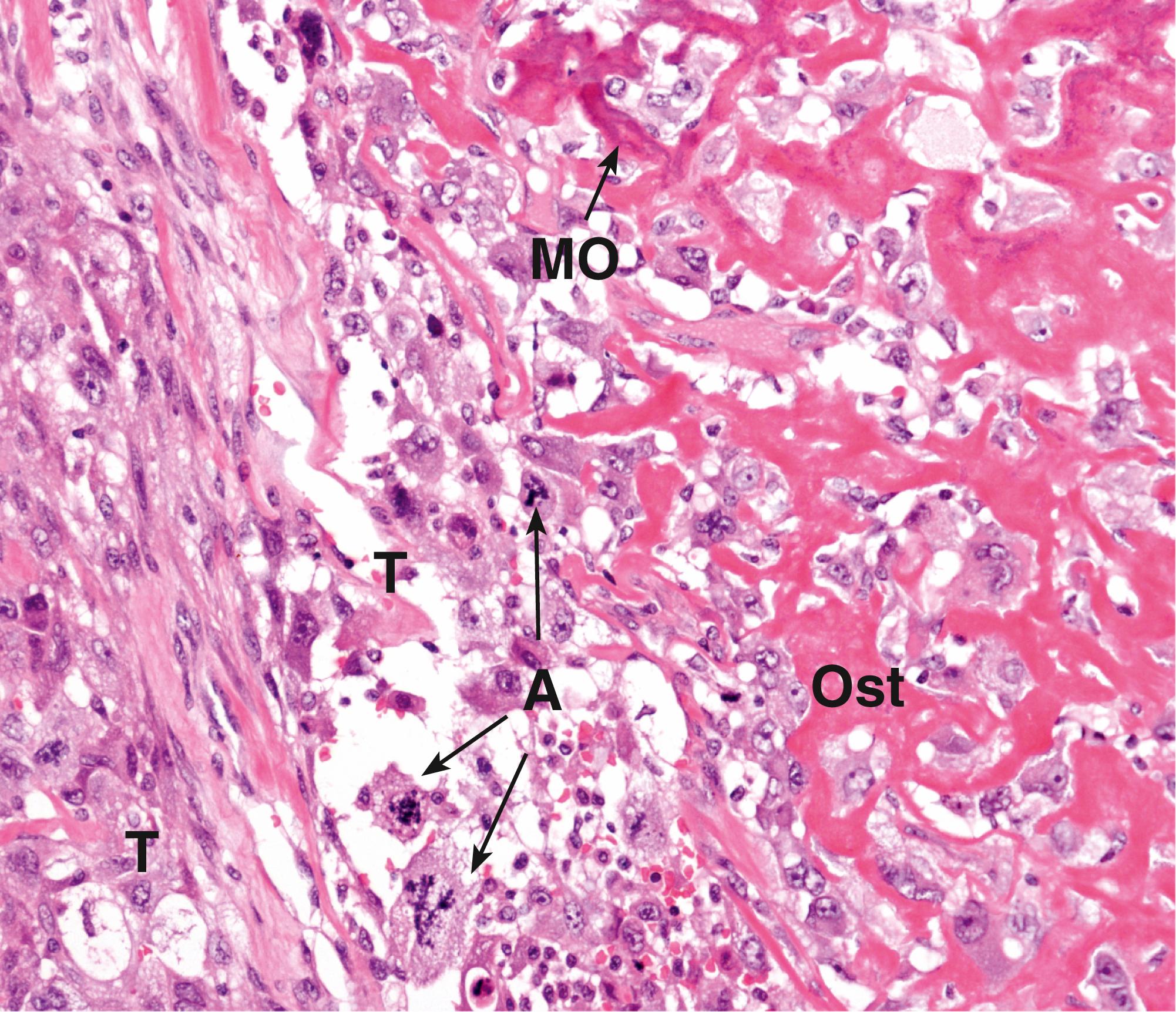 Fig. 22.5, Osteogenic sarcoma (osteosarcoma) (HP).