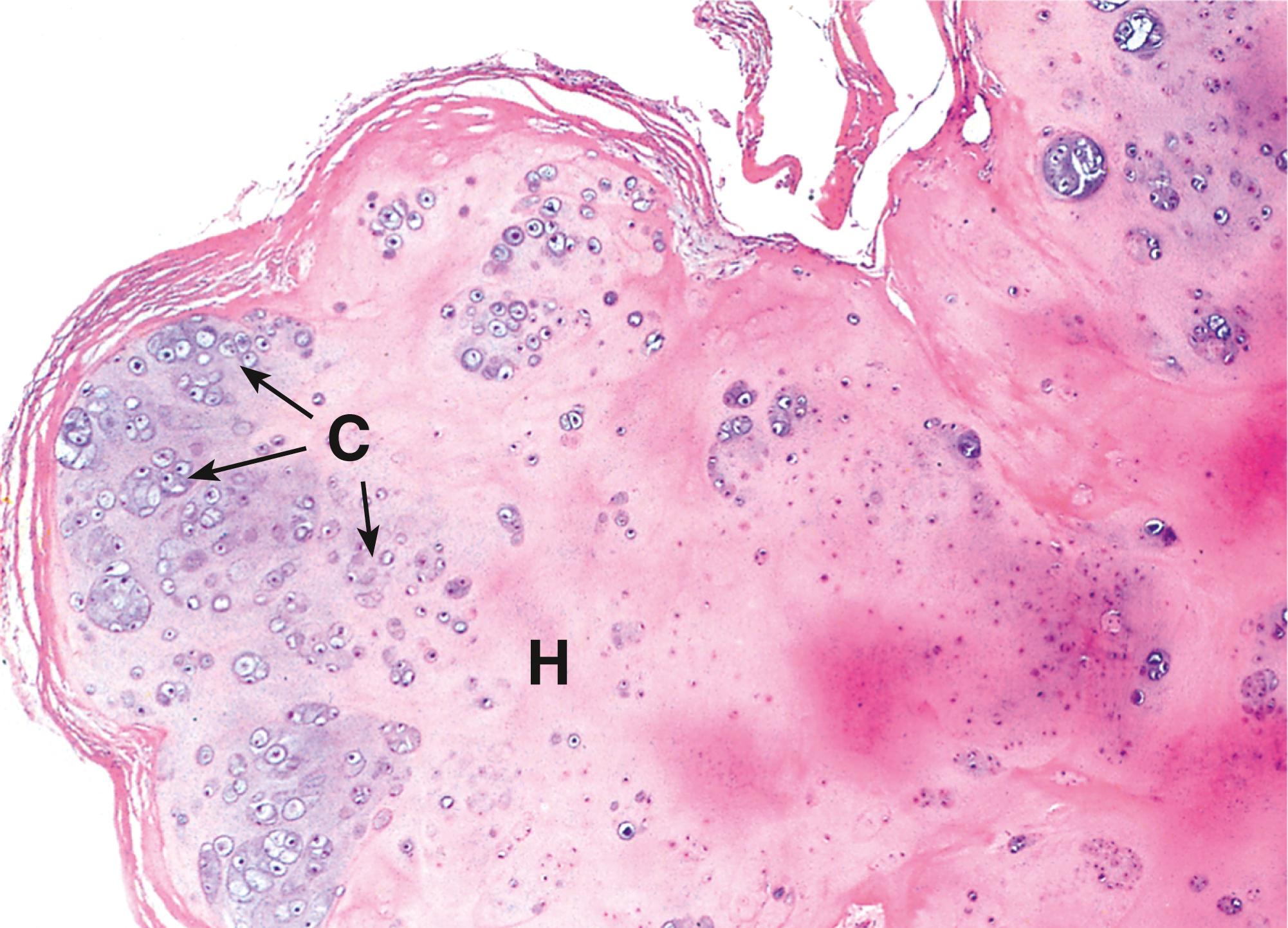 Fig. 22.6, Chondroma (LP).