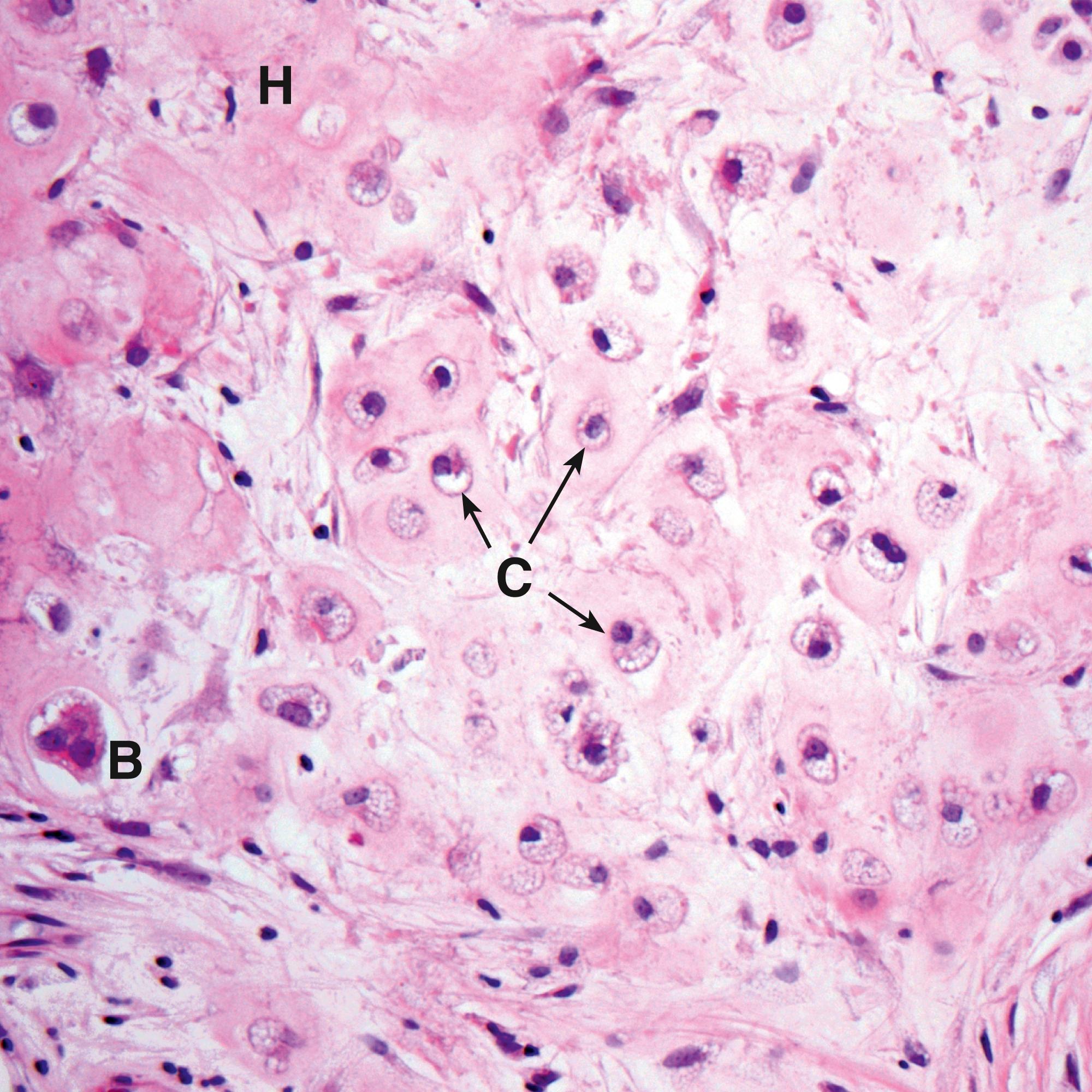 Fig. 22.7, Chondrosarcoma (HP).