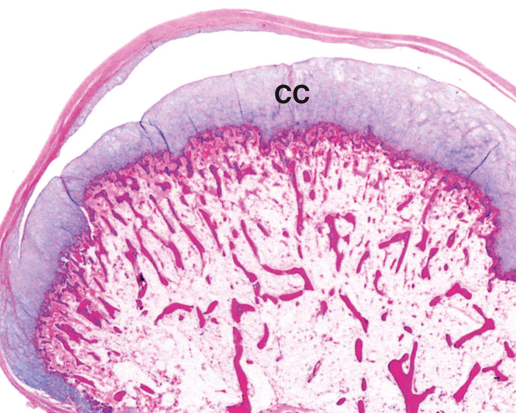 Fig. 22.8, Osteochondroma (LP).