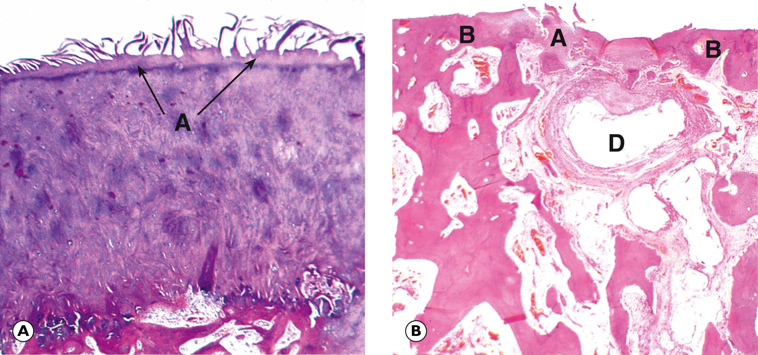 Fig. 22.9, Osteoarthritis. (A) Early changes (MP); (B) established lesion (LP).