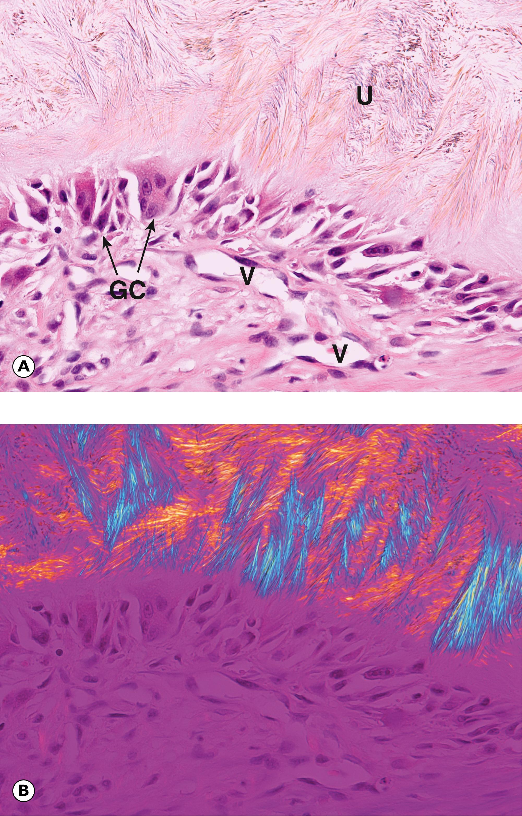 Fig. 22.10, Gout. (A) H&E (MP); (B) as above, viewed using plane polarised light.