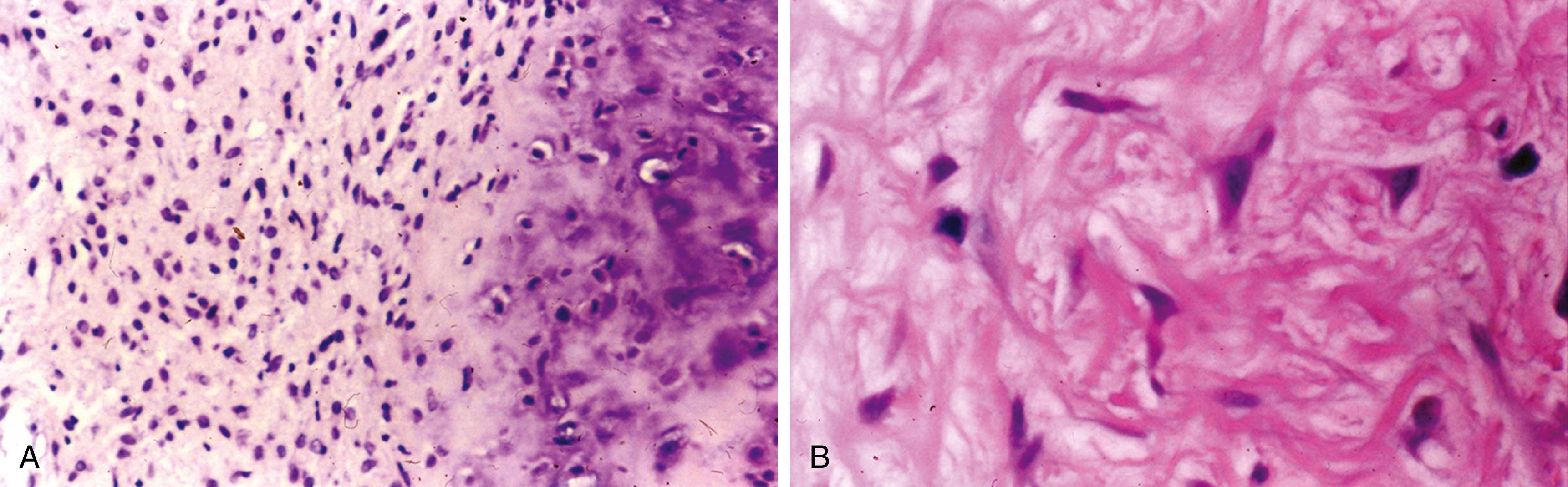 Fig. 16.11, Chondromyxoid fibroma.