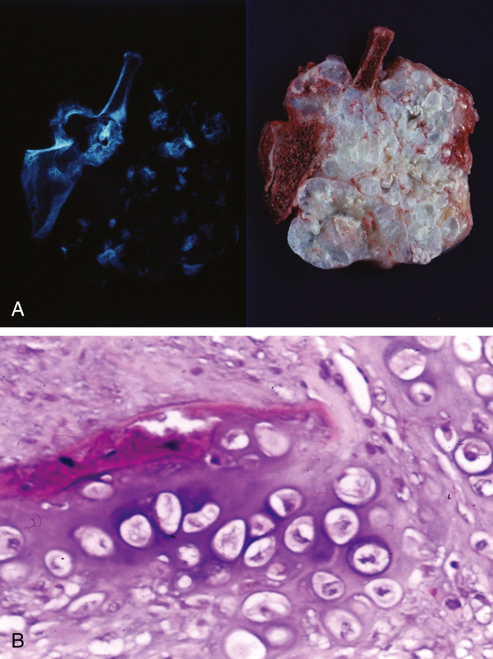 Fig. 16.12, Chondrosarcoma.