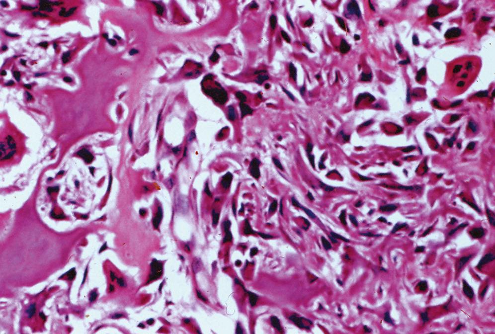 Fig. 16.2, Osteoid osteoma.