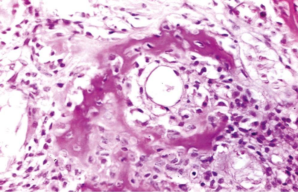 Fig. 16.3, Osteoblastoma.