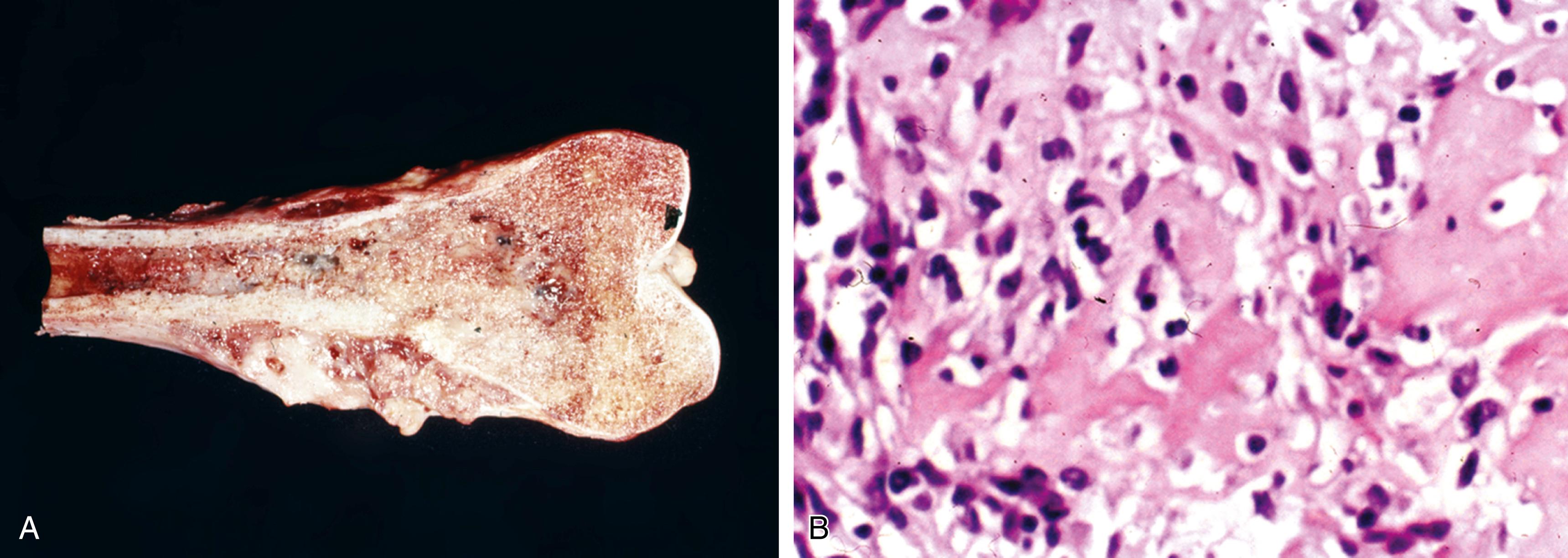 Fig. 16.4, Conventional osteosarcoma.