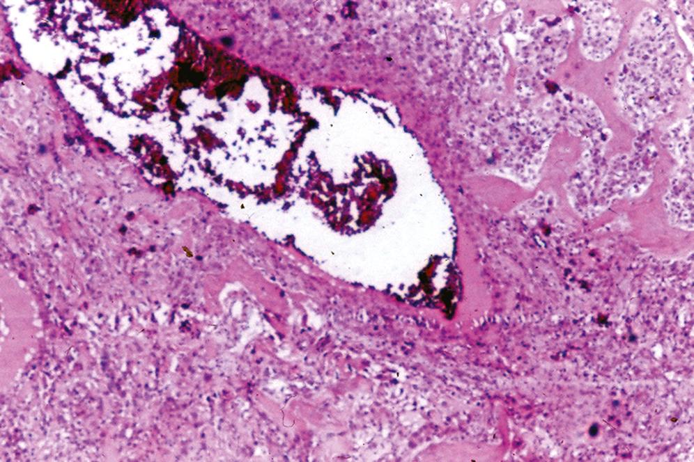 Fig. 16.5, Telangiectatic osteosarcoma.