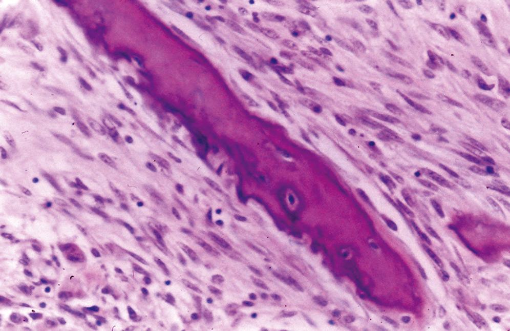 Fig. 16.6, Parosteal osteosarcoma.