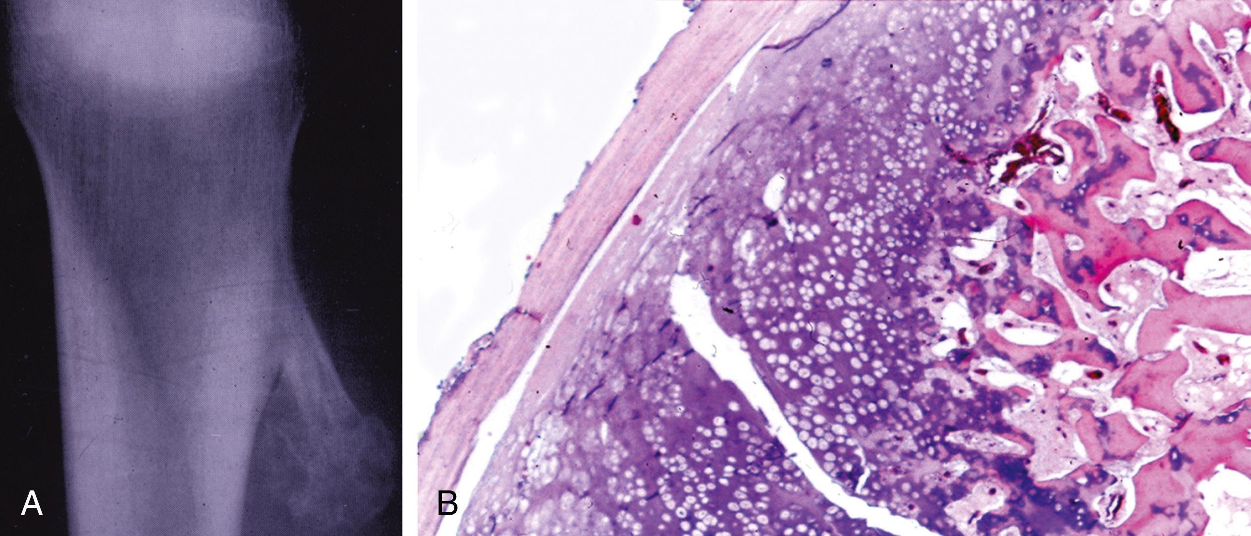 Fig. 16.7, Osteochondroma.