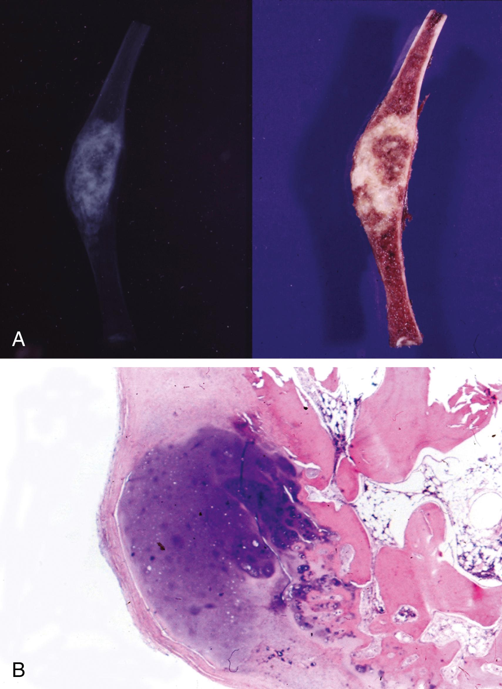 Fig. 16.8, Enchondroma.