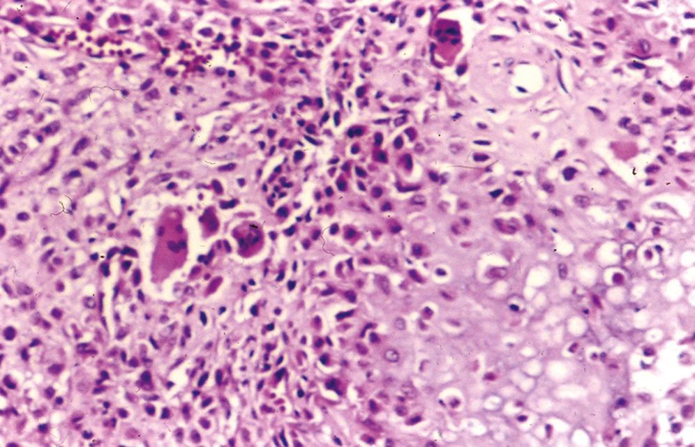 Fig. 16.10, Chondroblastoma.