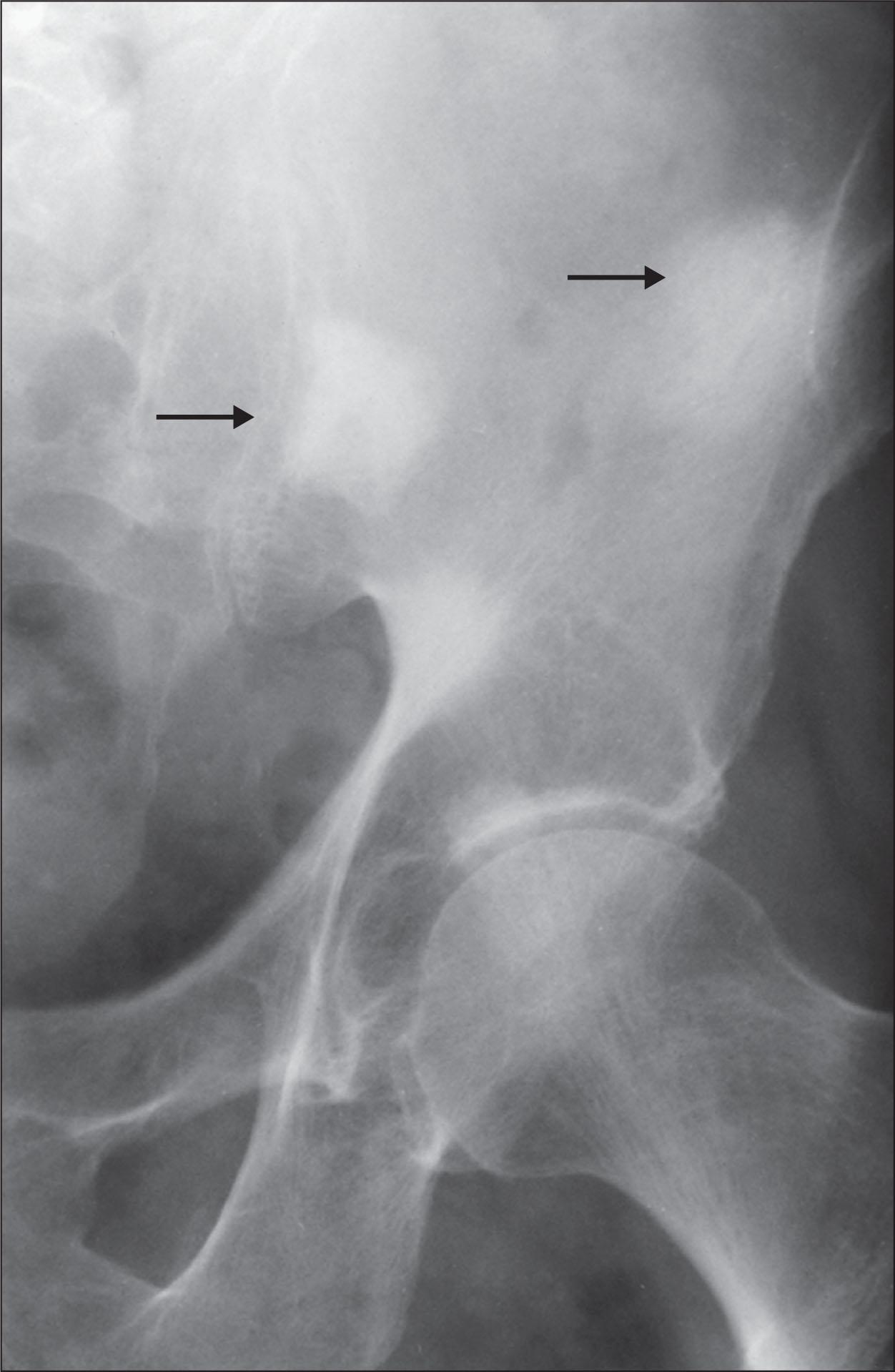 Fig. E218.1, X-ray of a pelvis showing poorly defined radiodense lesions (arrows) . These are osteoblastic metastases from metastatic breast carcinoma.