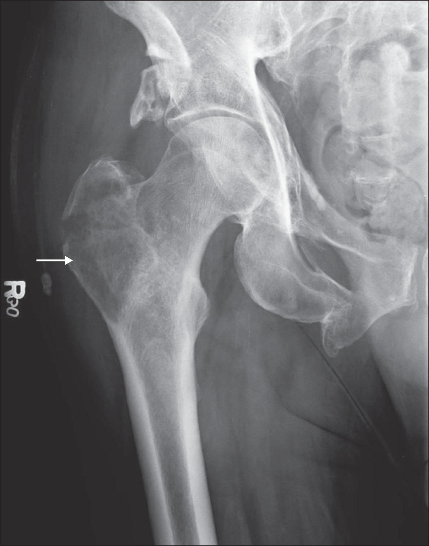 Fig. E218.2, X-ray of a proximal femur showing a poorly defined lytic lesion involving the greater trochanter of the proximal femur (arrow) . This is a focus of osteolytic metastatic lung cancer.