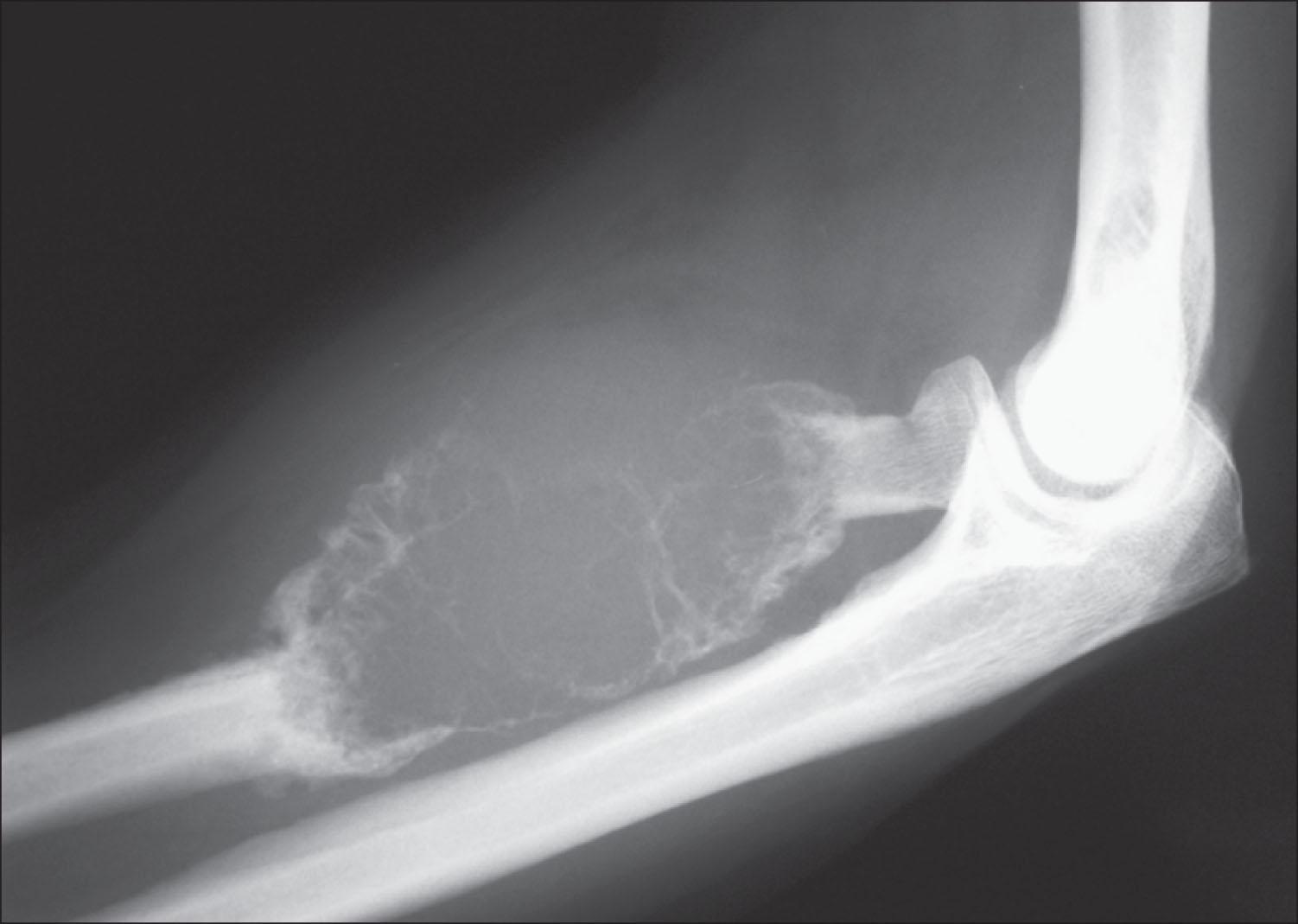 Fig. E218.4, X-ray of an expansile lytic lesion of the proximal radius. This is an example of a large focus of plasma cell myeloma.