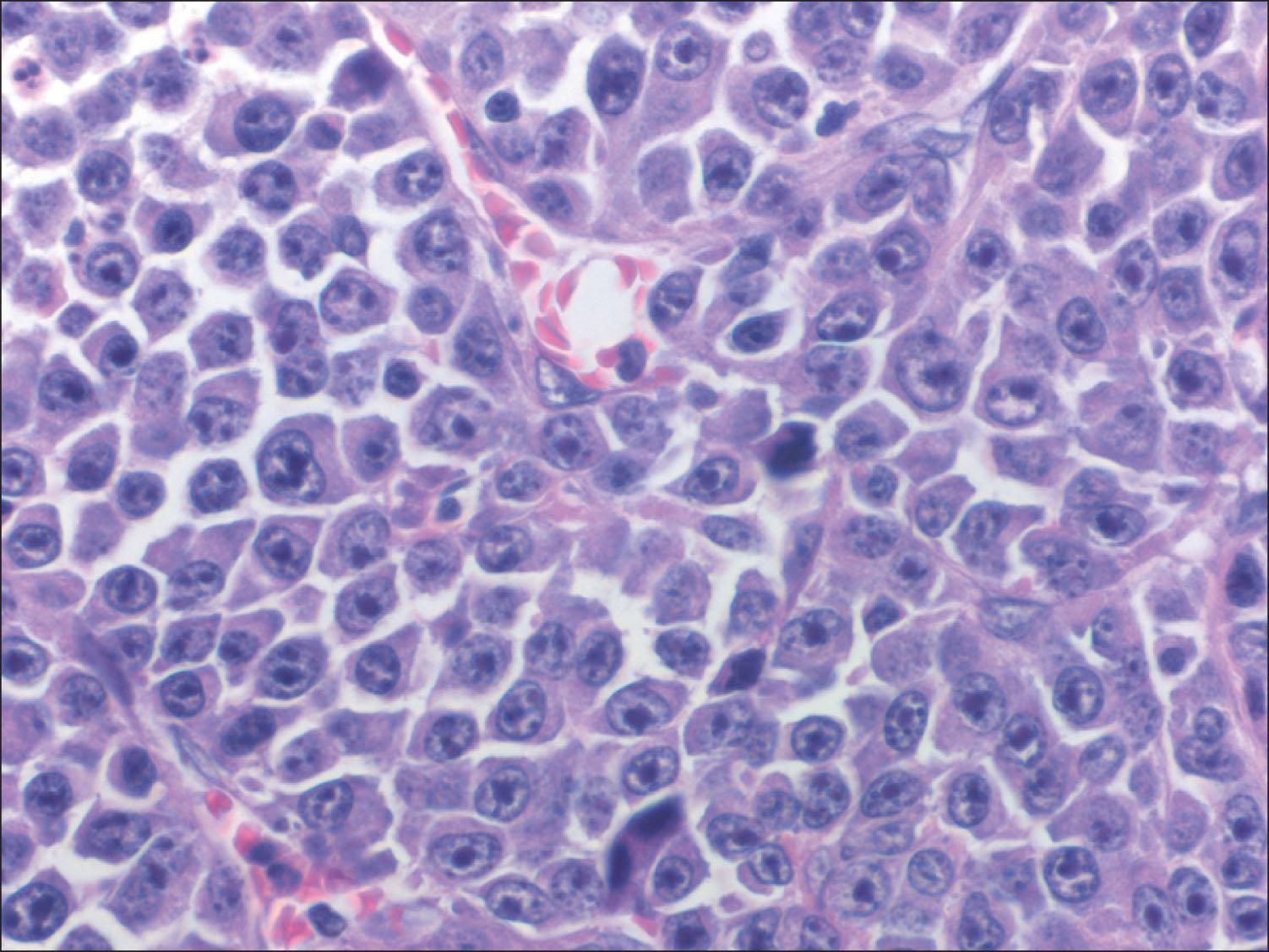 Fig. E218.5, Photomicrograph (40×) showing sheets of atypical malignant plasma cells.