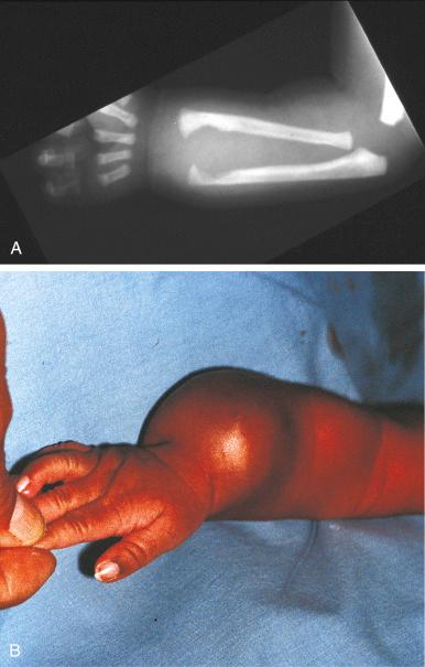 Fig. 9.12, Radiograph ( A ) and clinical photograph ( B ) of congenital fibrosarcoma in 1-day-old infant.