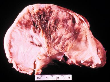 Fig. 9.13, Infantile fibrosarcoma of right shoulder in 1-month-old boy, showing marked interstitial hemorrhage.