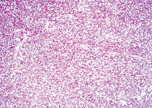 Fig. 9.14, Infantile fibrosarcoma composed of uniform, well-oriented fibroblasts arranged in fascicular growth pattern.