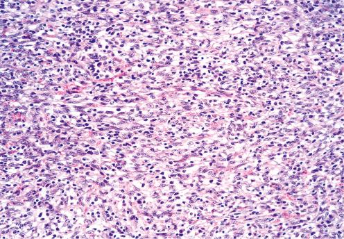 Fig. 9.15, Infantile fibrosarcoma with immature-appearing fibroblasts and intralesional lymphocytes.