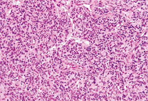 Fig. 9.17, Infantile fibrosarcoma composed of immature-appearing fibroblasts arranged around a prominent hemangiopericytoma-like vascular pattern.