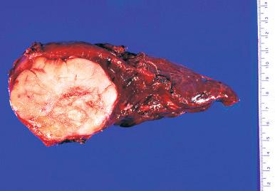 Fig. 9.19, Gross appearance of inflammatory myofibroblastic tumor in left upper lobe of lung of 21-year-old woman.