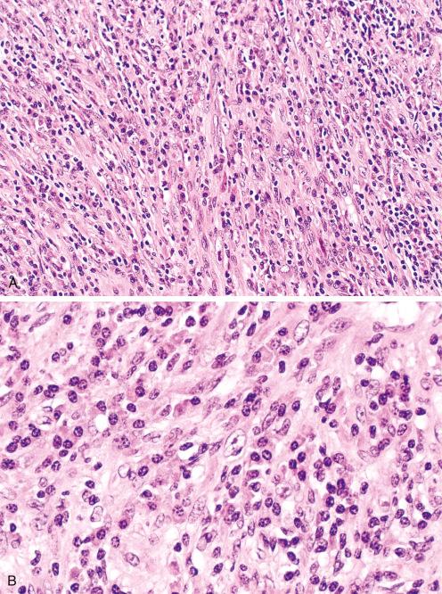 Fig. 9.20, Inflammatory myofibroblastic tumor.