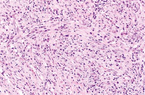 Fig. 9.21, Inflammatory myofibroblastic tumor.