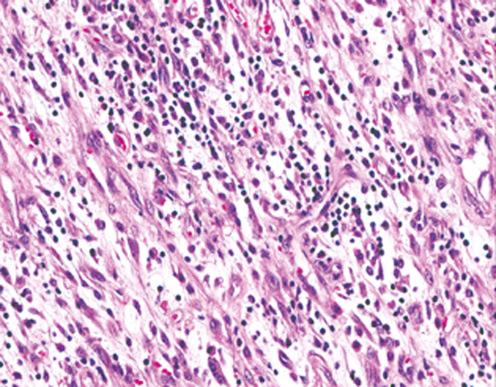 Fig. 9.22, High-power view of plump spindle-shaped cells admixed with inflammatory cells in inflammatory myofibroblastic tumor.