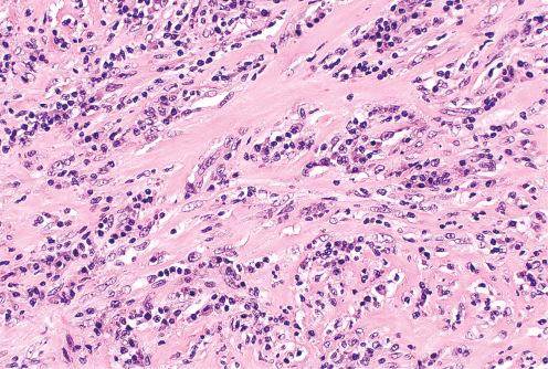 Fig. 9.23, Less cellular inflammatory myofibroblastic tumor than depicted in Figures 9.21 and 9.22 . Platelike collagen is present.