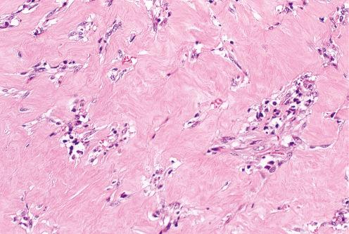 Fig. 9.24, Hypocellular inflammatory myofibroblastic tumor composed of predominantly sclerotic fibrous tissue with scattered spindle-shaped and inflammatory cells.