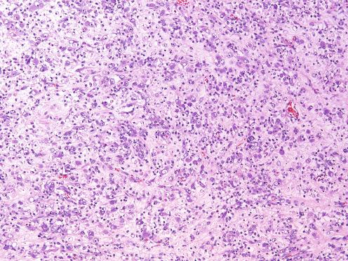 Fig. 9.25, Epithelioid inflammatory myofibroblastic sarcoma composed of sheets of atypical ganglion-like cells.