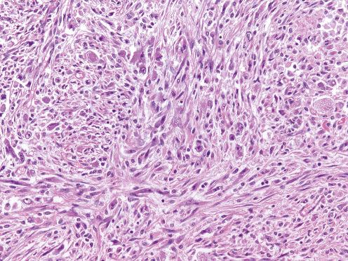 Fig. 9.26, Atypical spindled areas within an epithelioid inflammatory myofibroblastic tumor.