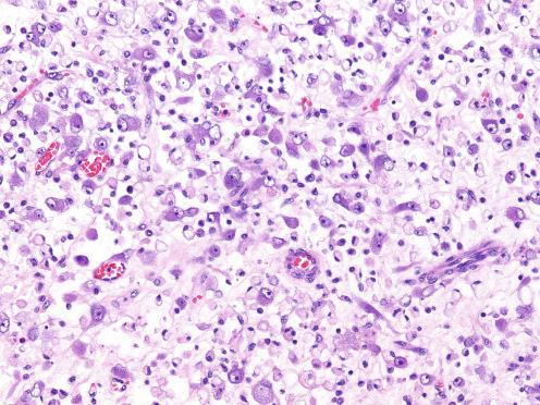 Fig. 9.27, High-power view of atypical ganglion-like cells in epithelioid inflammatory myofibroblastic sarcoma.