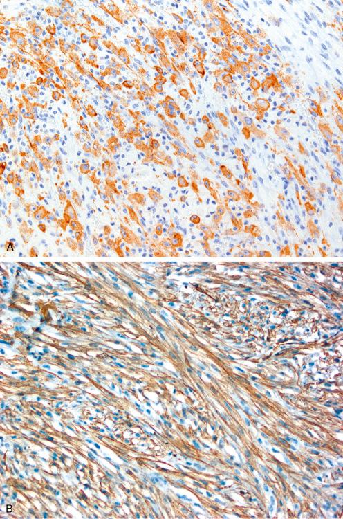 Fig. 9.28, Immunostaining in epithelioid inflammatory myofibroblastic sarcoma showing circumferential accentuation of ALK1 expression ( A ) and diffuse actin staining ( B ).